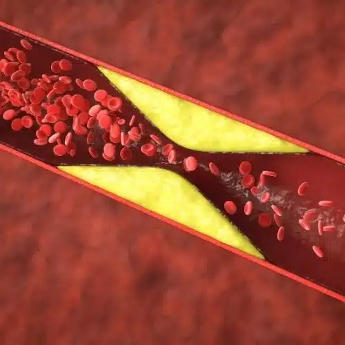 שקיעת כולסטרול בדם